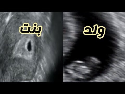 شكل سونار البنت ٤