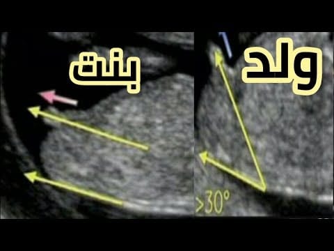 شكل سونار البنت ٢