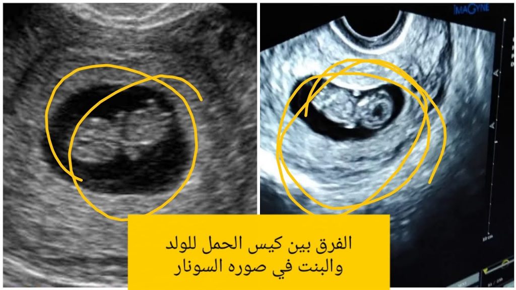 شكل كيس الجنين ونوعه بالصور1