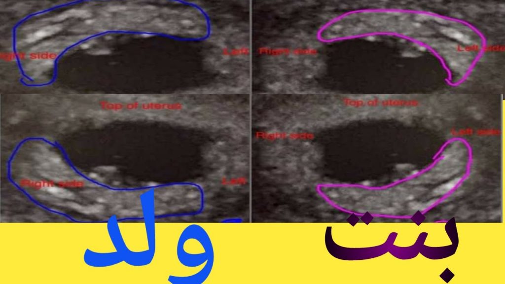 شكل كيس الجنين ونوعه بالصور2