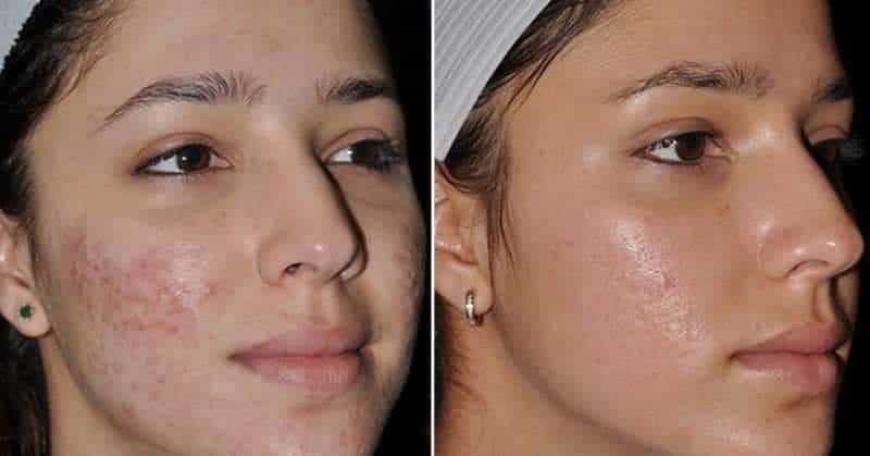 متى تظهر نتيجة الديرما رولر - قبل وبعد الديرما رولر 3