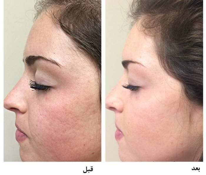 قبل وبعد الديرما رولر 4