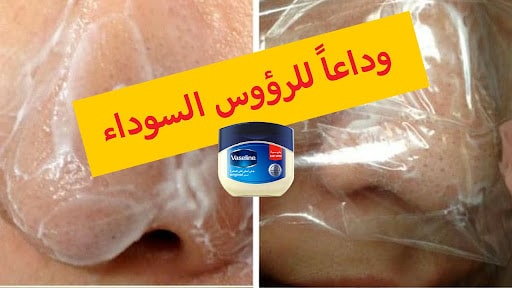 إزالة الرؤوس السوداء من الأنف بالفازلين