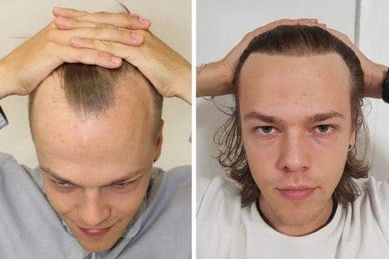 متى تظهر نتيجة زراعة الشعر