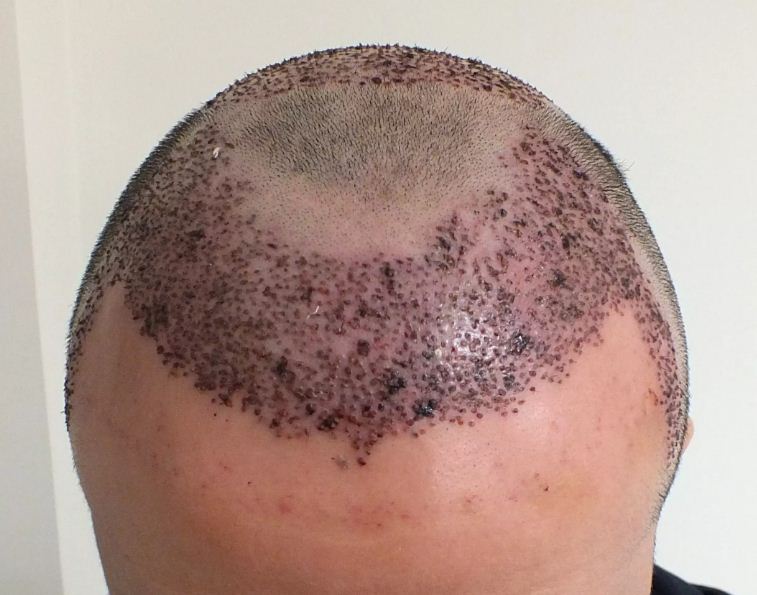 احمرار المنطقة المزروعة بعد زراعة الشعر
