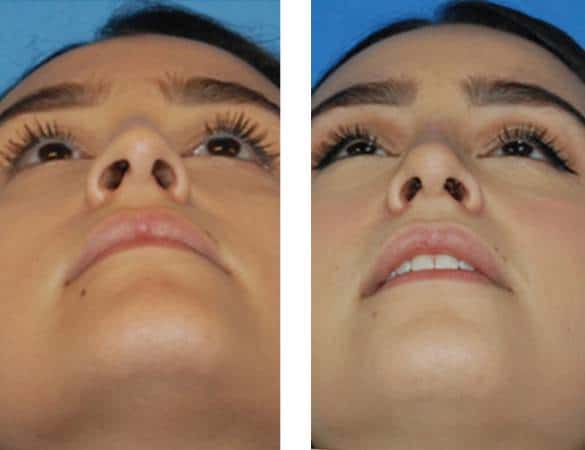 تجربتي مع عملية تجميل الأنف