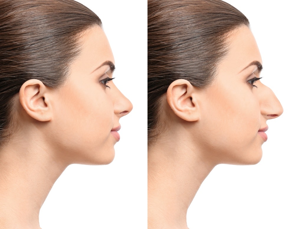 تجربتي مع عملية تجميل الأنف