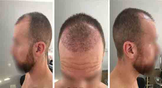 الشهر الثاني من زراعة الشعر