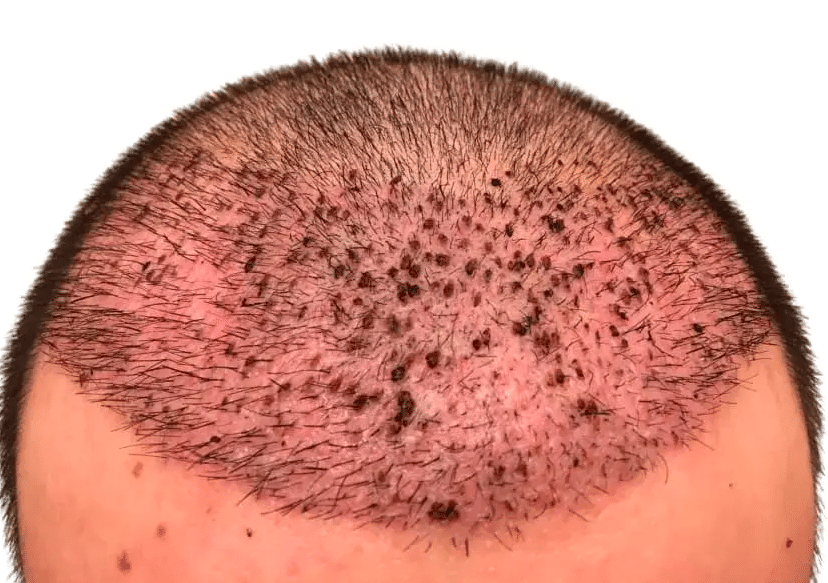 أضرار زراعة الشعر