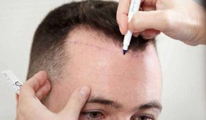 متى تظهر نتيجة زراعة الشعر