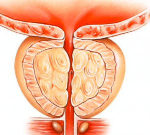 أقوى مضاد حيوي لعلاج التهاب البروستاتا