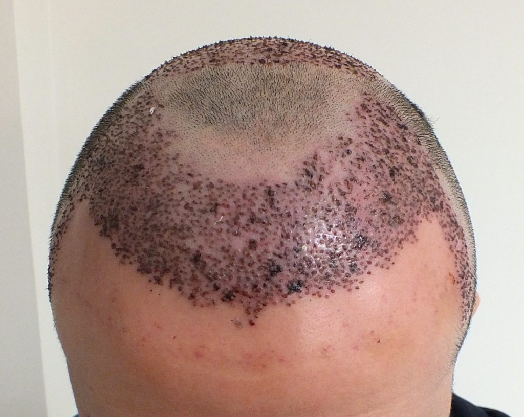 متى تثبت البصيلات بعد زراعة الشعر