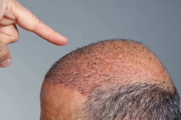 نتائج زراعة الشعر بعد 3 شهور
