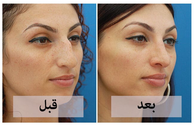 تجربتي مع خيوط الأنف