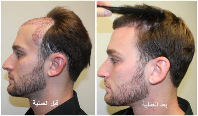 نتائج زراعة الشعر بعد سنتين