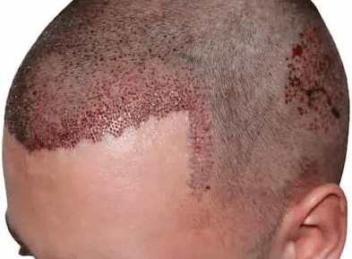 احمرار المنطقة المزروعة بعد زراعة الشعر