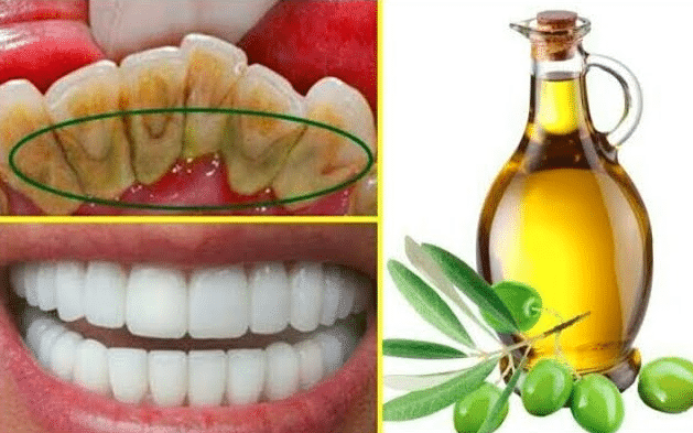 إزالة جير الأسنان بزيت الزيتون
