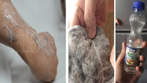 طريقة إزالة الشعر نهائيا بالخل
