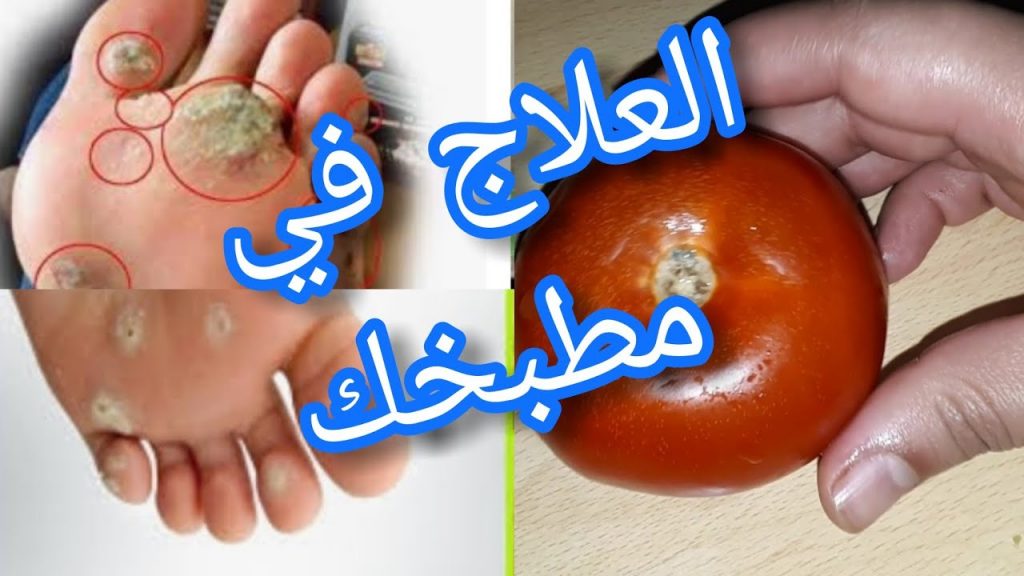 علاج مسمار اللحم بالبندورة