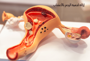 إزالة لحمية الرحم بالأعشاب