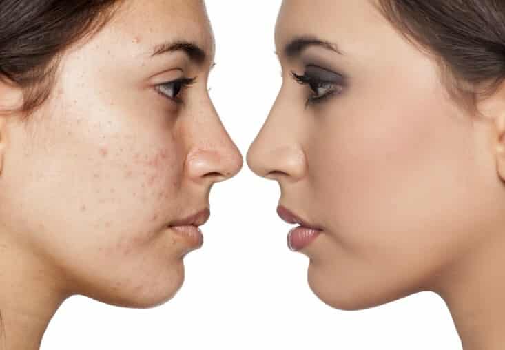 إزالة البقع من الوجه نهائيًا