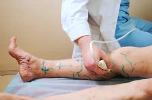 أفضل دكتور دوالي الساقين في الكويت
