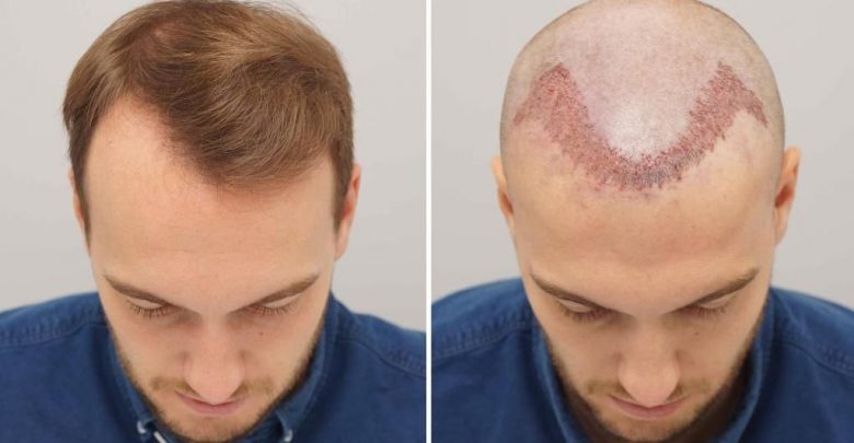 1زراعة الشعر في تركيا قبل وبعد