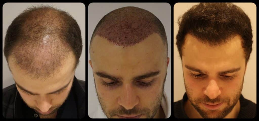 2زراعة الشعر في تركيا قبل وبعد