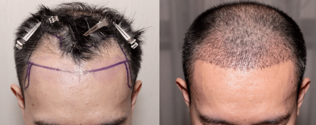 3زراعة الشعر في تركيا قبل وبعد