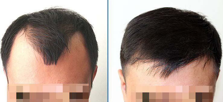 4زراعة الشعر في تركيا قبل وبعد
