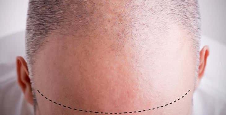 زراعَة الشعر في تُركيا