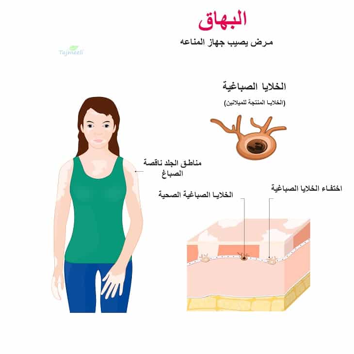 ليس كل بياض بهاق