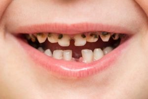 تجربتي في علاج التسوس