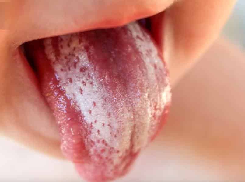 أسباب فطريات الفم