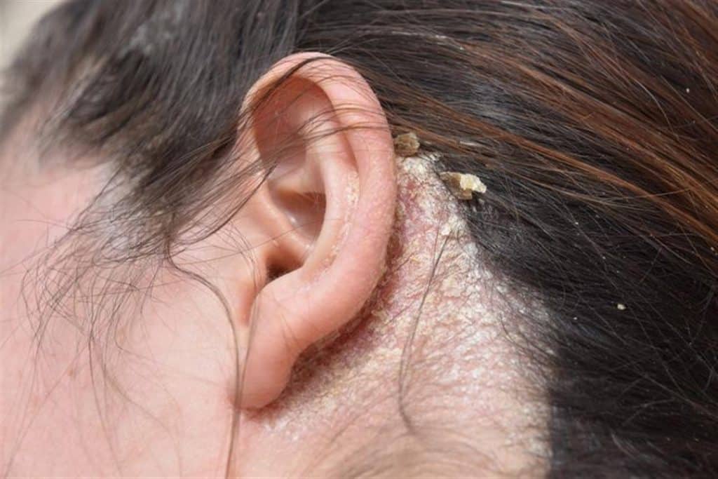 أعراض فطريات الشعر