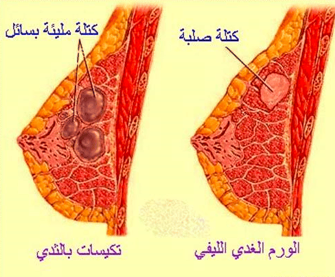 هل تتحول أكياس الثدي إلى سرطان