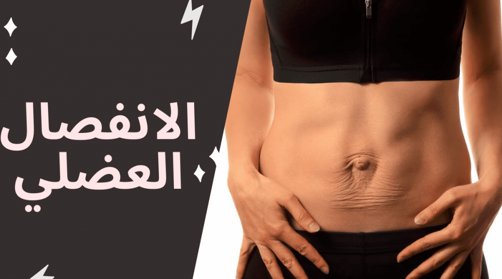 تجاربكم مع الانفصال العضلي للبطن