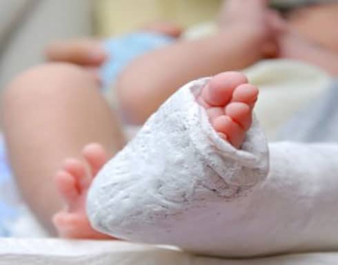 مدة علاج لين العظام عند الأطفال