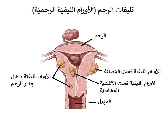 تجربتي مع تليف الرحم