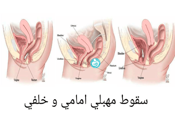 الفرق بين هبوط الرحم هبوط المثانة