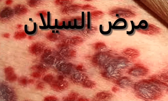 تجربتي مع مرض السيلان