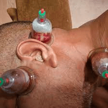 علاج مرض منيير بالحجامه