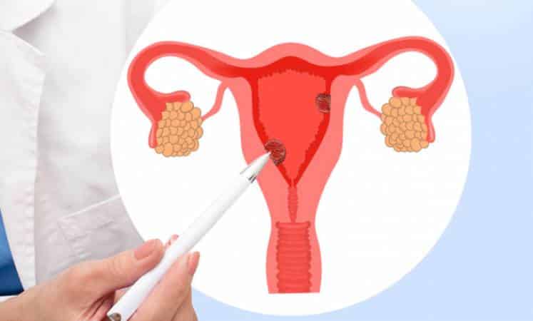 تجربتي مع لحمية الرحم والحمل