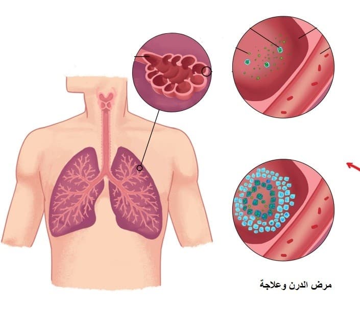 هل مرض الدرن يسبب الوفاة