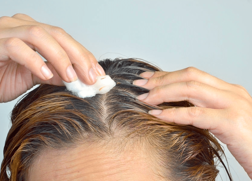محلول فطريات الشعر