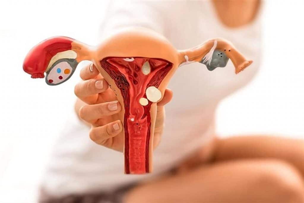 أضرار عملية لحمية الرحم