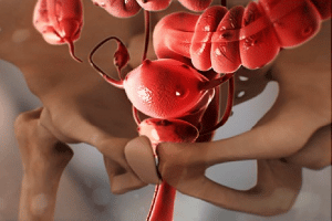 تجربتي مع بطانة الرحم المهاجرة