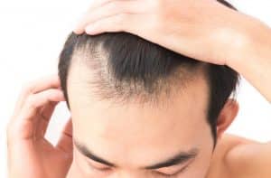 مميزات وعيوب زراعة الشعر