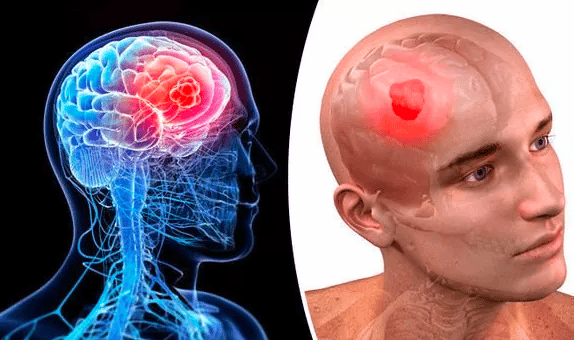 أسباب ورم الدماغ