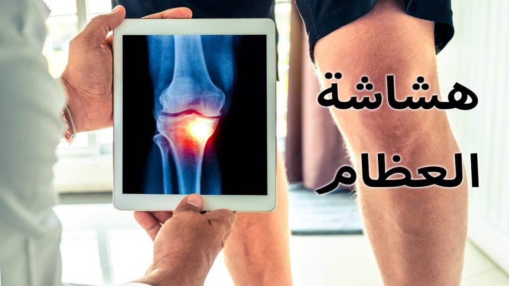 أعراض هشاشة العظام